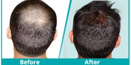What Makes The Best Hair Transplant Surgeon