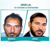 About Enhance Hair Transplant Clinic & Services in Delhi