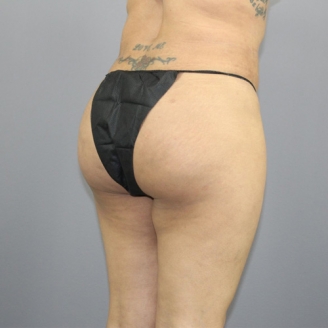 Buttock liposuction in Delhi 