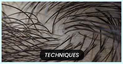 Techniques of Hair Transplant