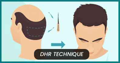 FUE Hair Transplant in Delhi FUE Hair Transplant Treatment in Delhi