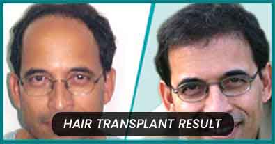 Top 5 Celebrities who have had Hair transplant  YouTube