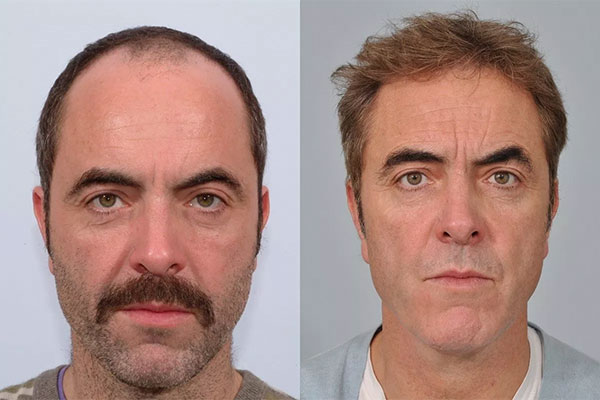 Hair Transplant Results