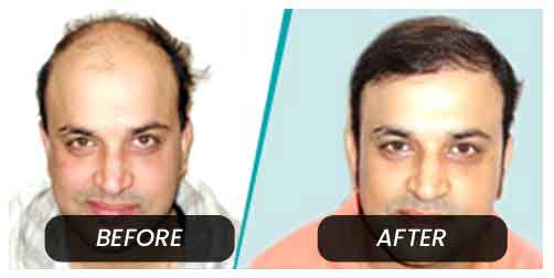 Hair Transplant in India