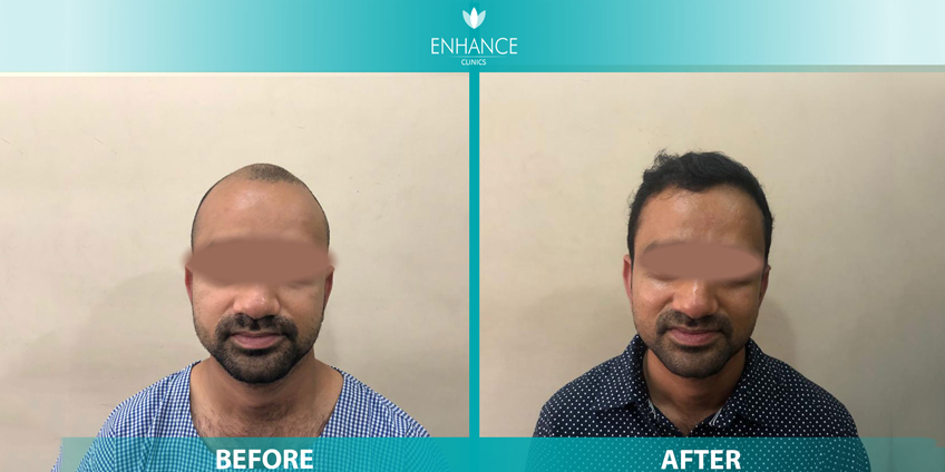 DHR Hair Transplant Cost in Delhi