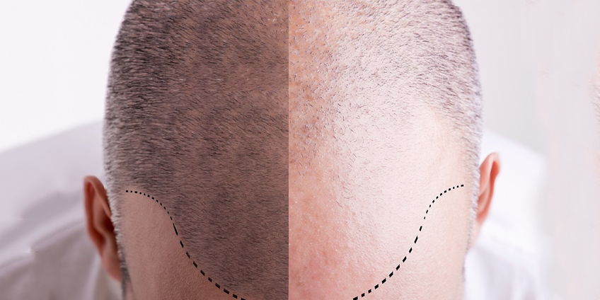 Difference between PRP Treatment and Scalp Micropigmentation