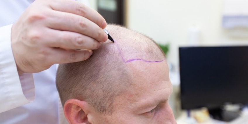 The Booming Industry of Hair transplant