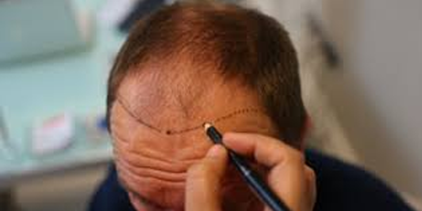 How to Get the Best Quality Hair Transplant in Delhi?