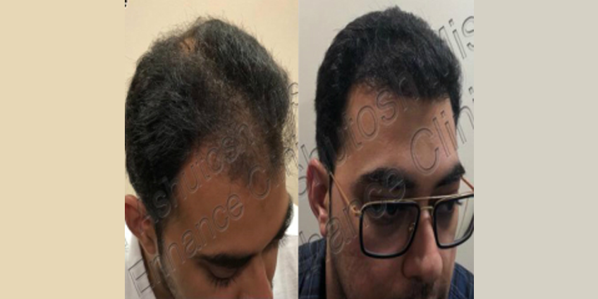 How to Repair a Bad Hair Transplant?