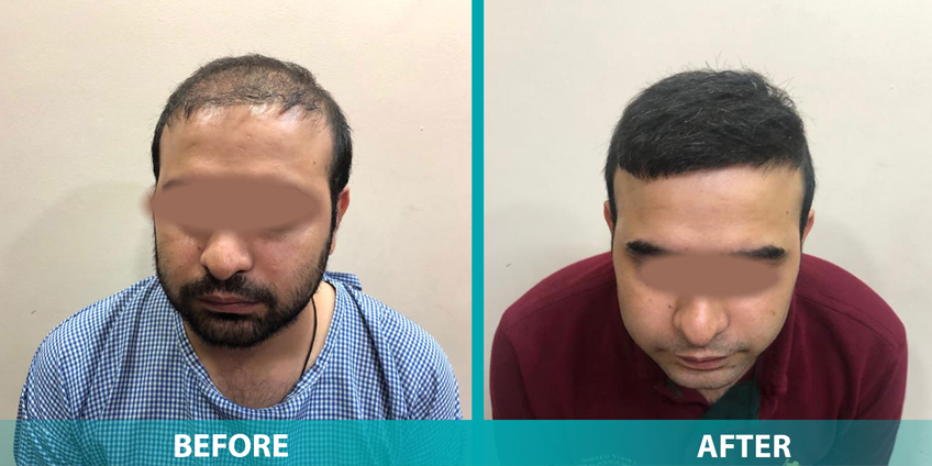 Is Hair Transplant a Permanent Treatment or Not
