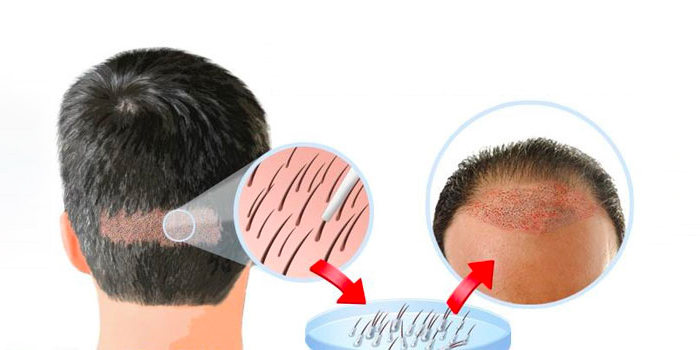 The Cost Of Hair Transplantation In India