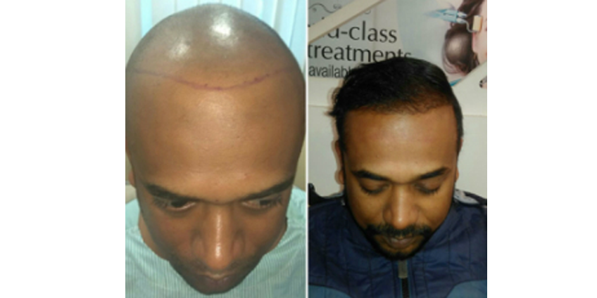 Things to Know Before Planning Your Hair Transplant in Delhi