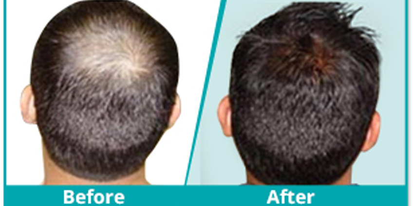 Hair Transplant Patna