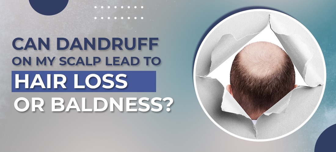 Can Dandruff on my Scalp lead to Hair Loss or Baldness? 