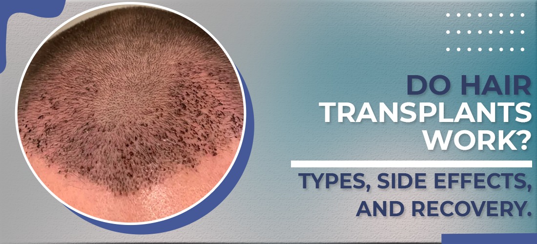  Do Hair Transplants Work? Types, Side Effects, and Recovery.