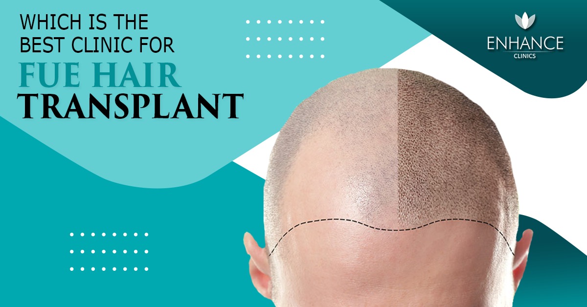 Which is The Best Clinic for FUE Hair Transplant in Delhi?  