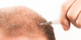 A Complete Guide To Have Best Quality Hair Transplant In Delhi
