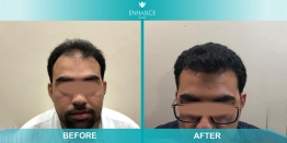 DHR Hair Transplant Cost in Mumbai