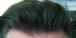 Hairline Design Treatment in Delhi