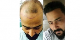 How Much Does A Hair Transplant Cost In India?