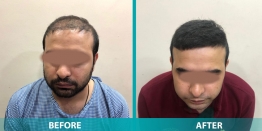 Is Hair Transplant a Permanent Treatment or Not