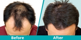 Reshape your hairline with Enhance Clinics