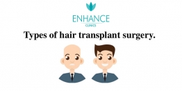 What are the Popular Types of Hair Transplants