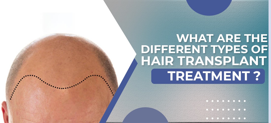 What are the different types of hair transplant treatment?
