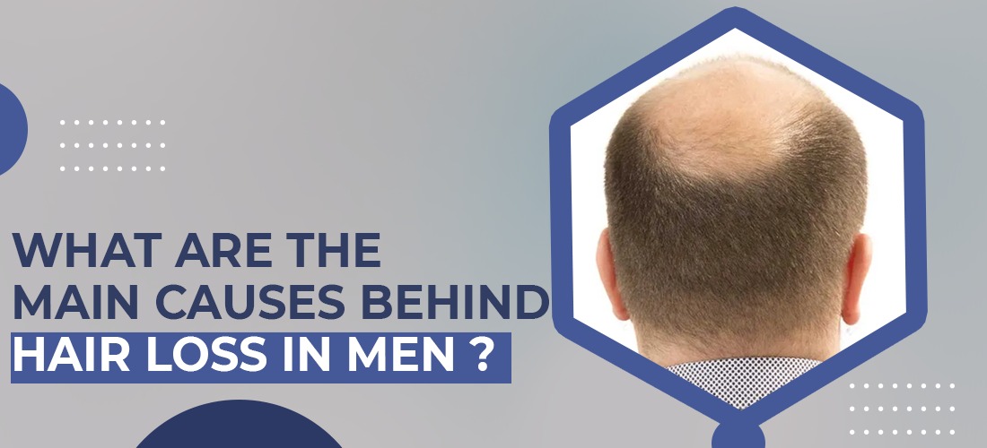 What are the Main Causes behind Hair Loss in Men?