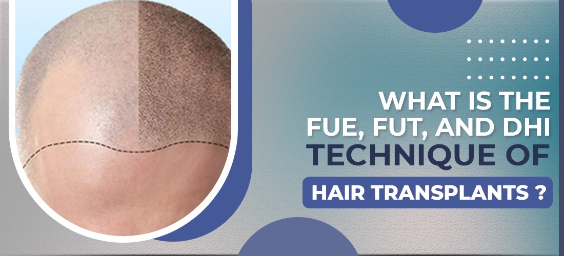  What is the FUE, FUT, and DHI technique of Hair Transplants?