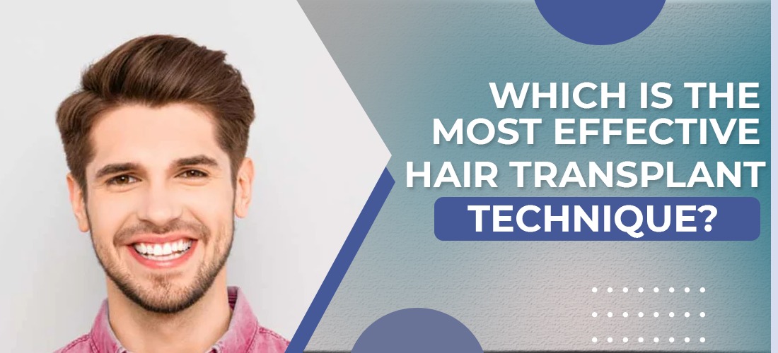  Which is the Most Effective Hair Transplant Technique?