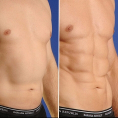 Abdominal Liposuction Surgery in Delhi 