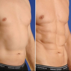 Abdominal Liposuction Surgery in Delhi 