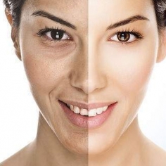 Anti Aging Fillers Treatment in Delhi 