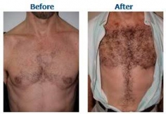 Body Hair Transplant 