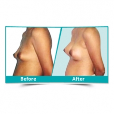 Breast Augmentation in Delhi 