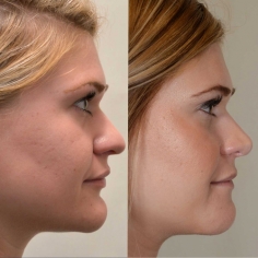 Chin Liposuction Surgery in Delhi 