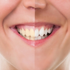 Cosmetic Dentistry in Delhi 