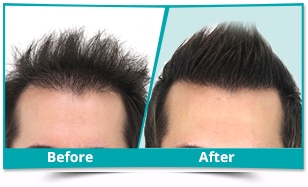 DHR Technique for Hair Loss in Delhi 