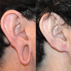 Earlobe Repair Surgery in Delhi 