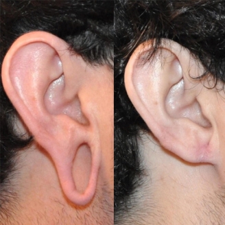 Ear Lobe Repair in South Delhi, Saket