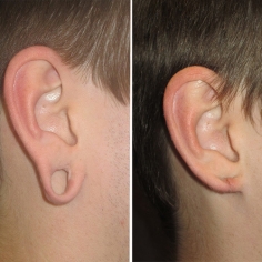 Ear Repair Surgery in Delhi 