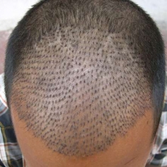 FUE Hair Transplant