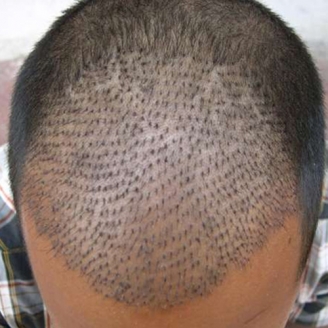 Toronto FUE (Follicular Unit Extraction) Hair Transplant