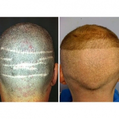 FUE vs FUT Hair Transplant 