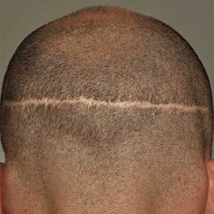 FUT Hair Transplant