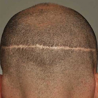 FUT Hair Transplant in Delhi 