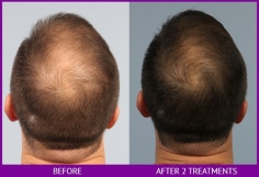 Failed Hair Transplant Repair