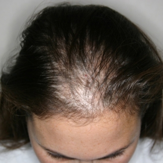 Female Hair Loss Treatment in Delhi, Causes, Types | Hair Loss in Women