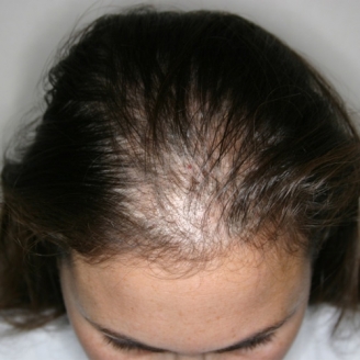 PRP Treatment For Hair Loss In DelhiCosmetic Dermatology India